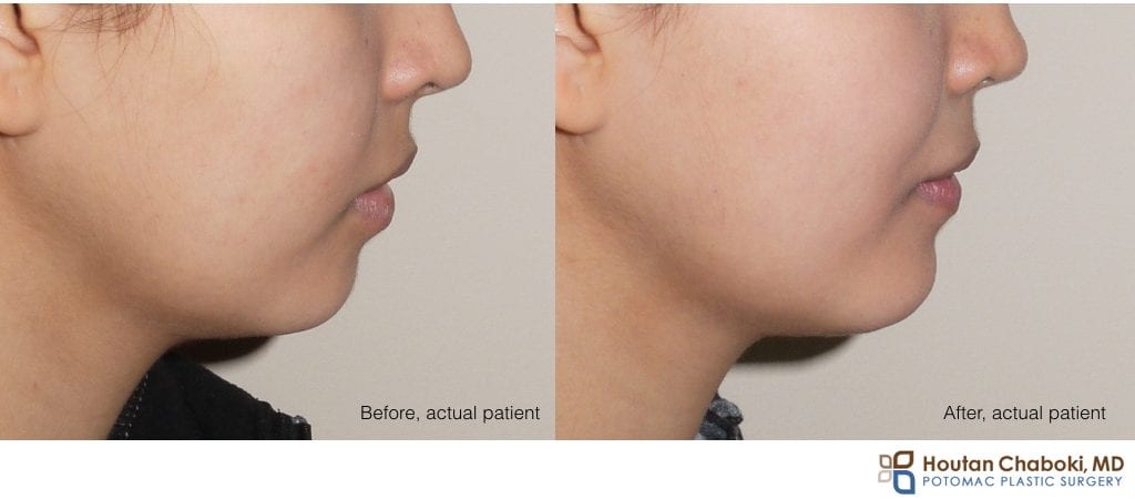 Blog post - before after chin augmentation plastic surgery implant silicone size medium