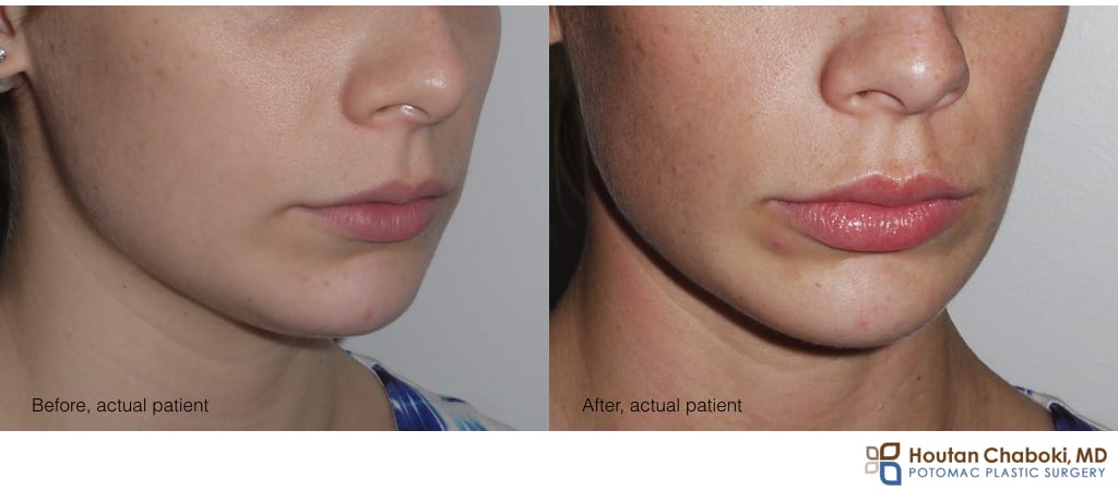 Blog post - before after lip injection hyaluronic acid Juvederm woman