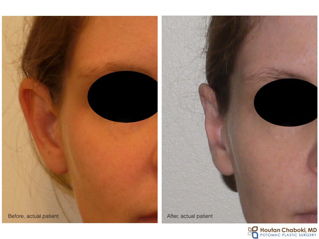 Blog post - before after photo ear surgery otoplasty