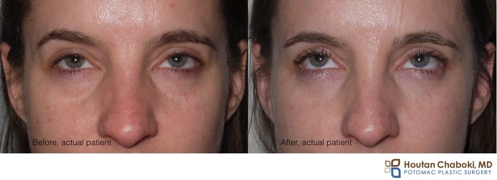 Blog post - before after photo puffy lower eye cosmetic