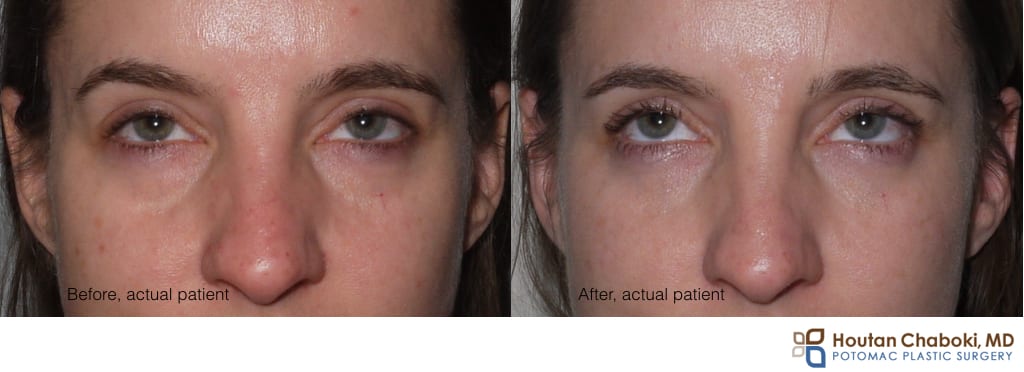 Blog post - before after photo puffy lower eye cosmetic