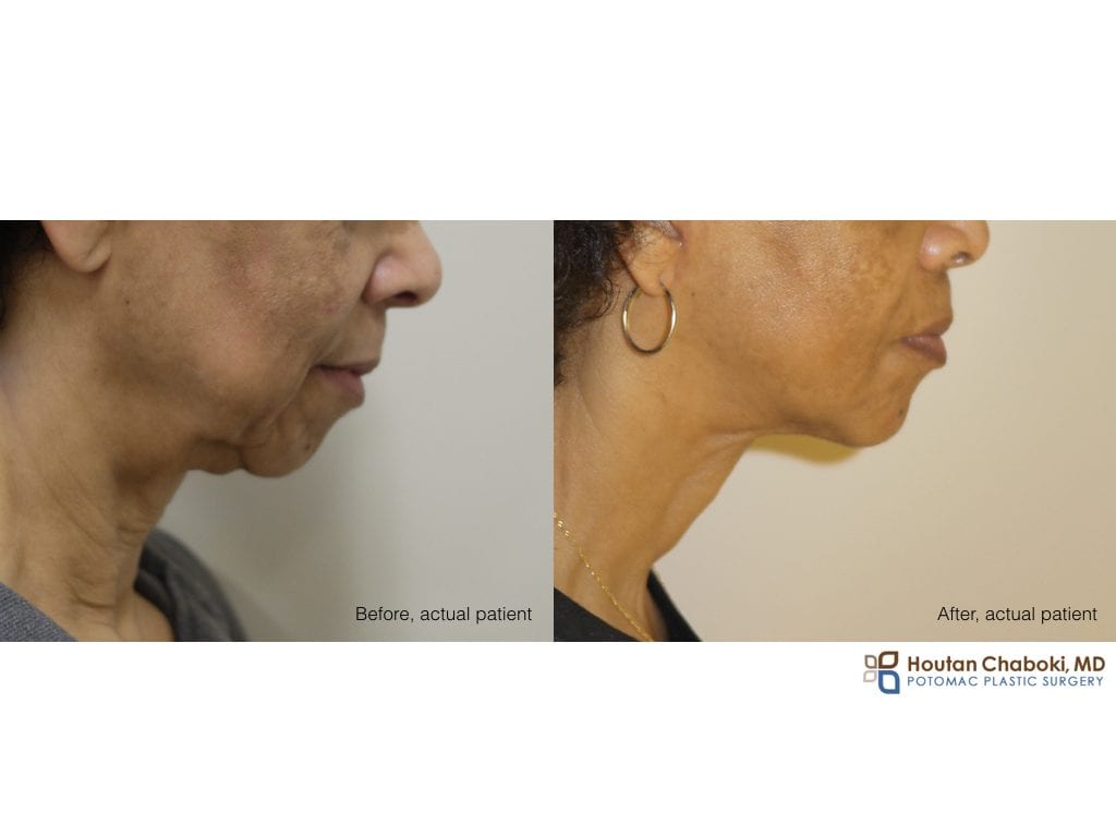Blog post - facelift neck lift sagging skin chin implant