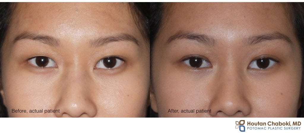 Blog post - before after Asian blepharoplasty double eyelid surgery DC