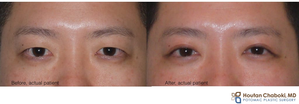 Blog post - before after Asian blepharoplasty double eyelid surgery DC