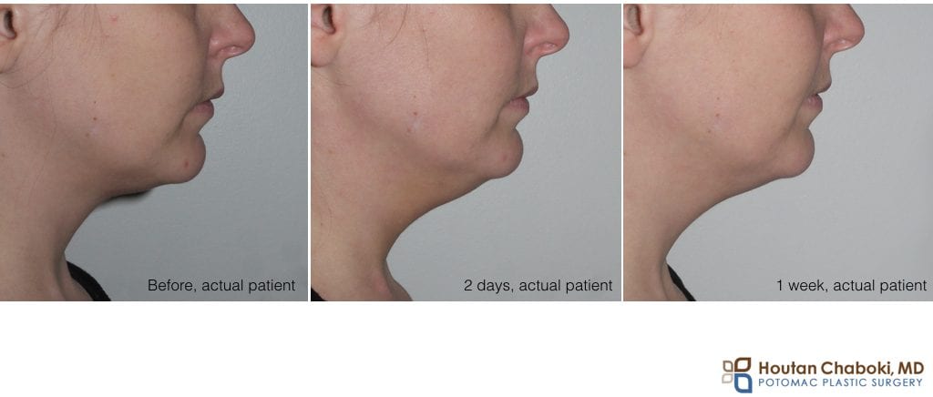 Blog post - before after photograph Kybella recovery submental fullness neck fat