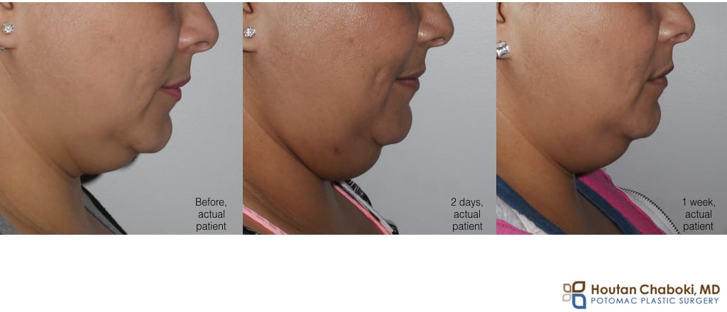 Blog post - before after photograph Kybella recovery submental fullness neck fat