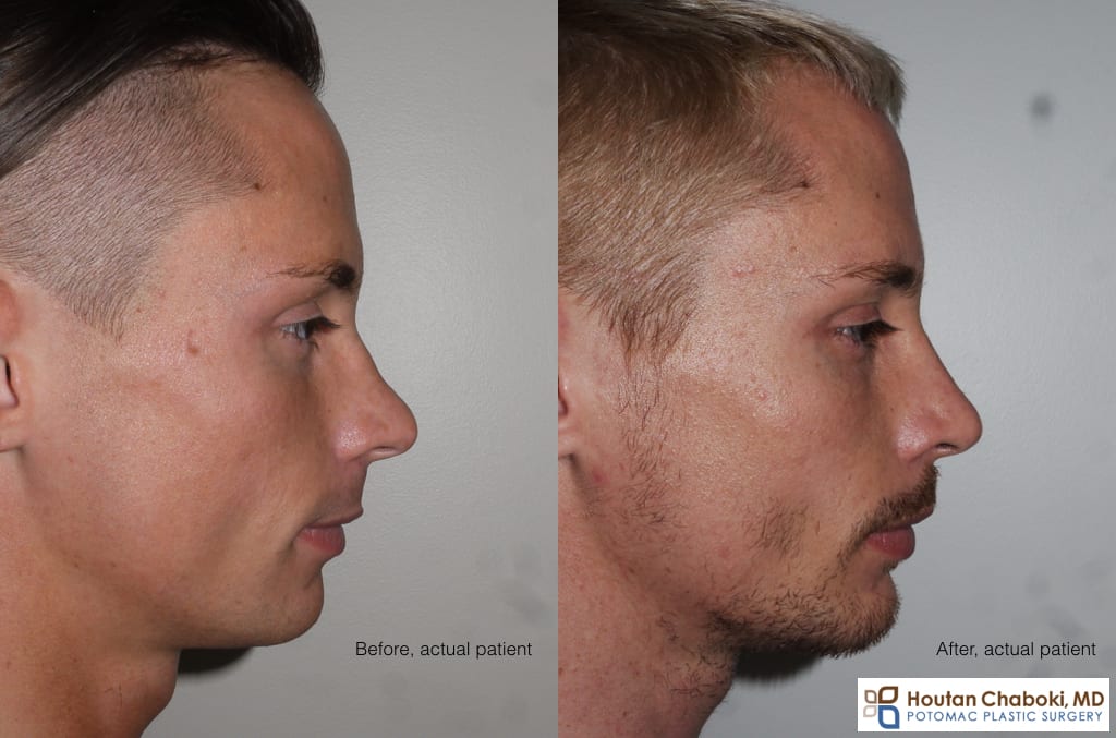 Blog post - male facial aesthetics rhinoplasty chin implant