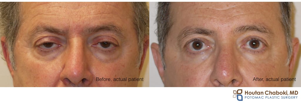 Blog post - male facial aesthetics eyelid surgery brow lift