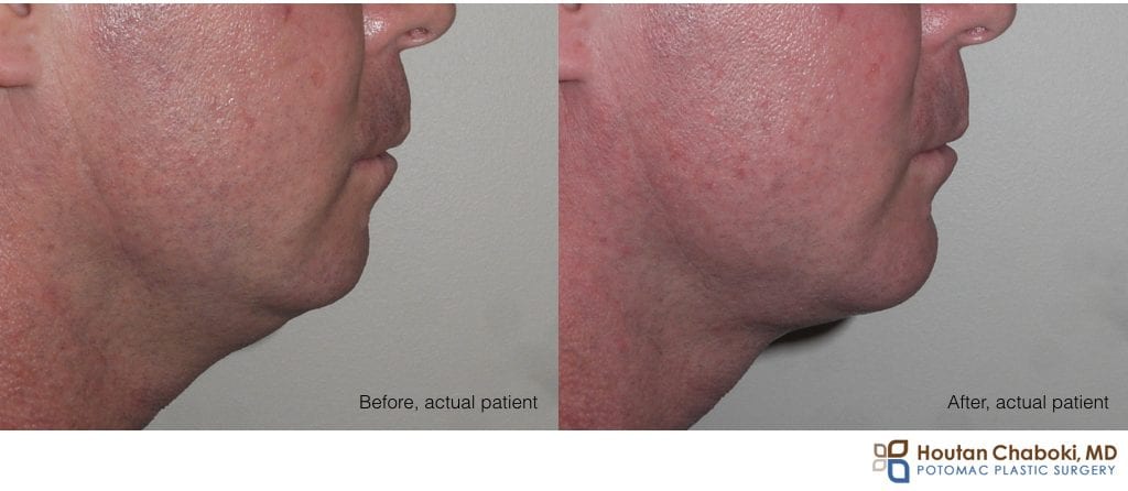 Blog post - male facial aesthetics chin implant liposuction