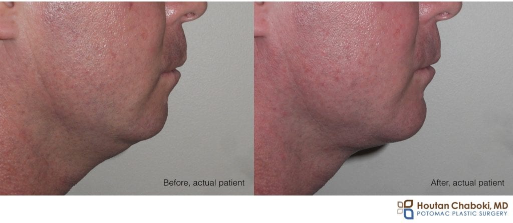 Blog post - male facial aesthetics chin implant liposuction