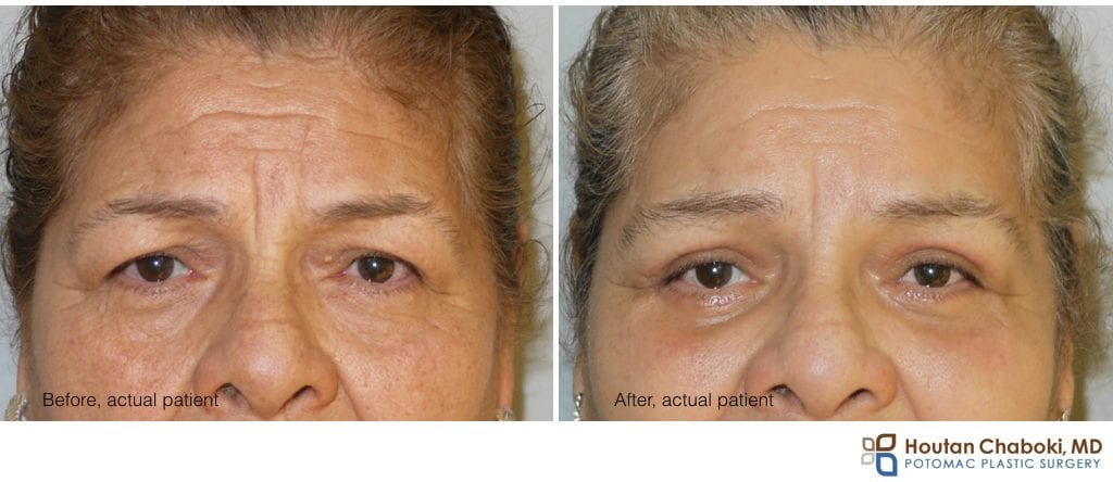 Blog post - before after brow lift upper lower eyelid surgery bleph Botox
