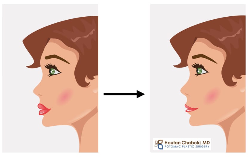 Blog post - hyaluronidase injection reverse HA facial filler