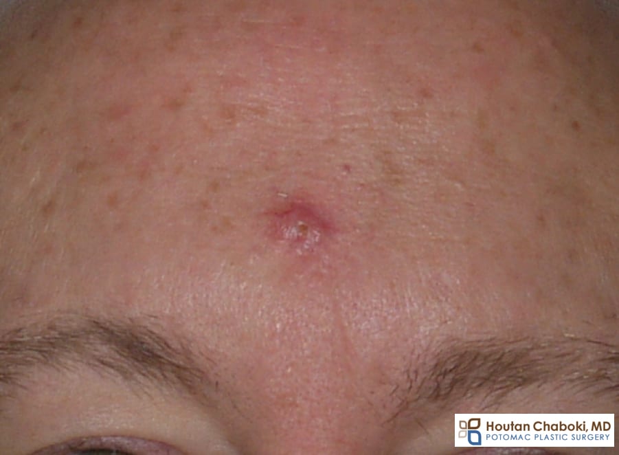 Blog post - basal cell skin cancer face plastic surgery