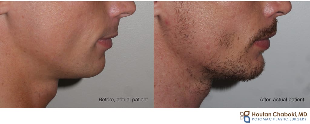 Blog post - before after chin augmentation silicone implant neck lift