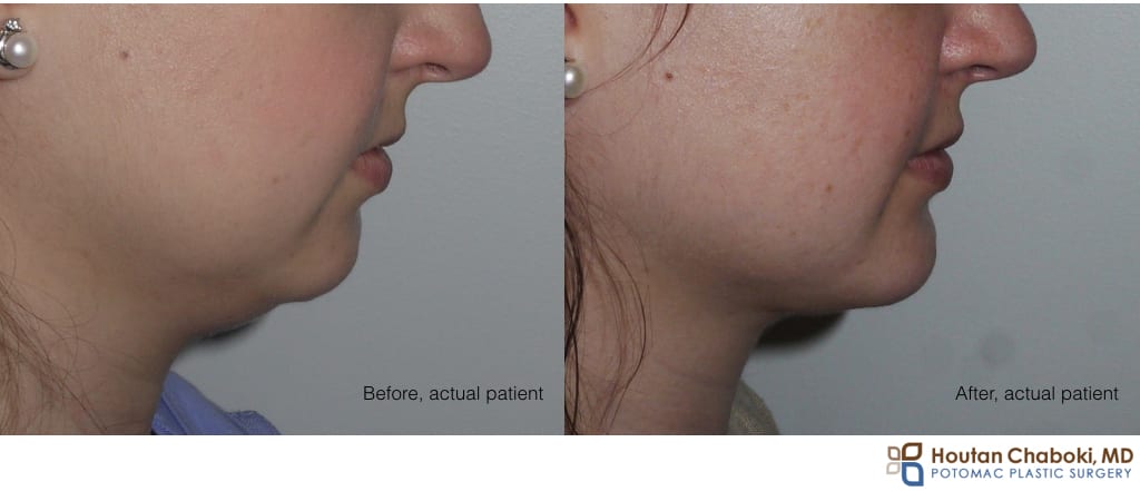 Blog post - before after chin augmentation silicone implant neck lift