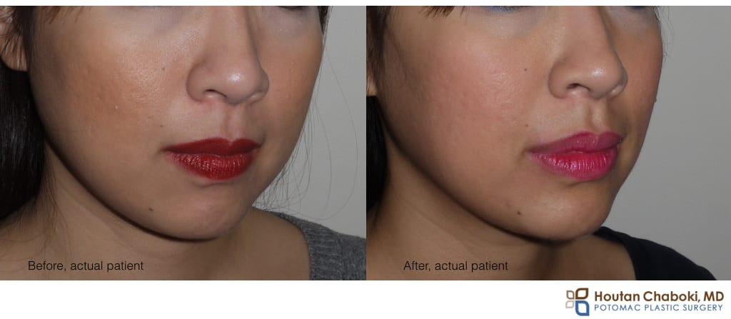 Blog post - before after liquid facelift cheek eye lip facial filler