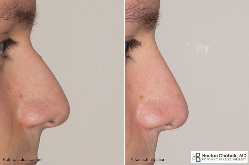 Blog post - before after nonsurgical rhinoplasty facial filler Restylane nose