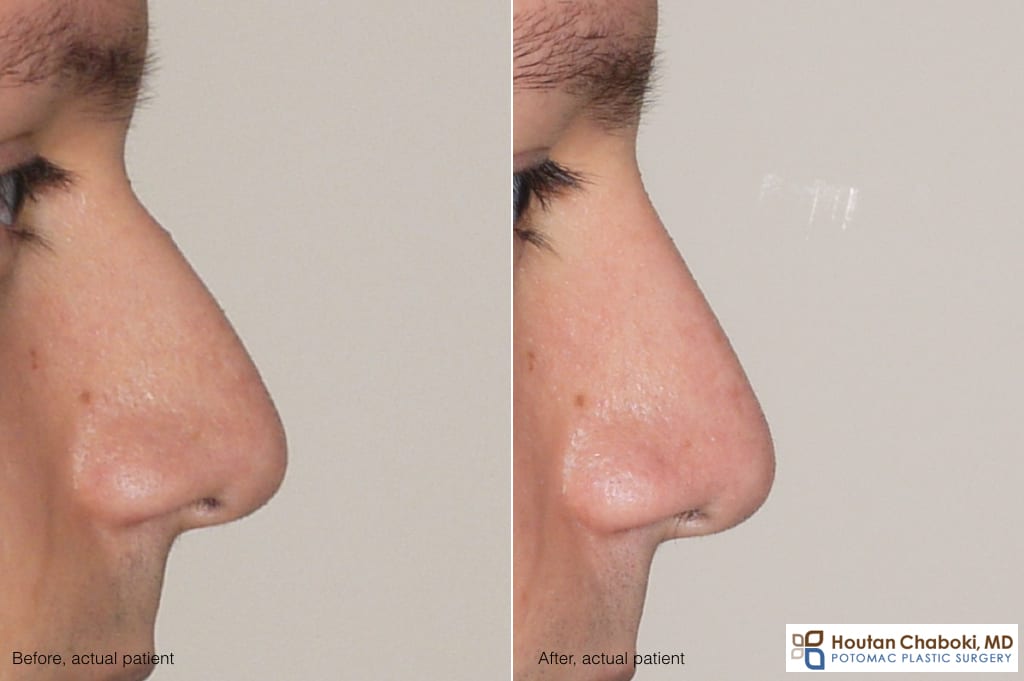Blog post - before after nonsurgical rhinoplasty facial filler Restylane nose
