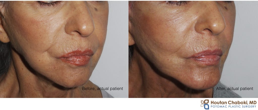 Blog post - before after photo fat transfer stem cell regenerative cheek facelift