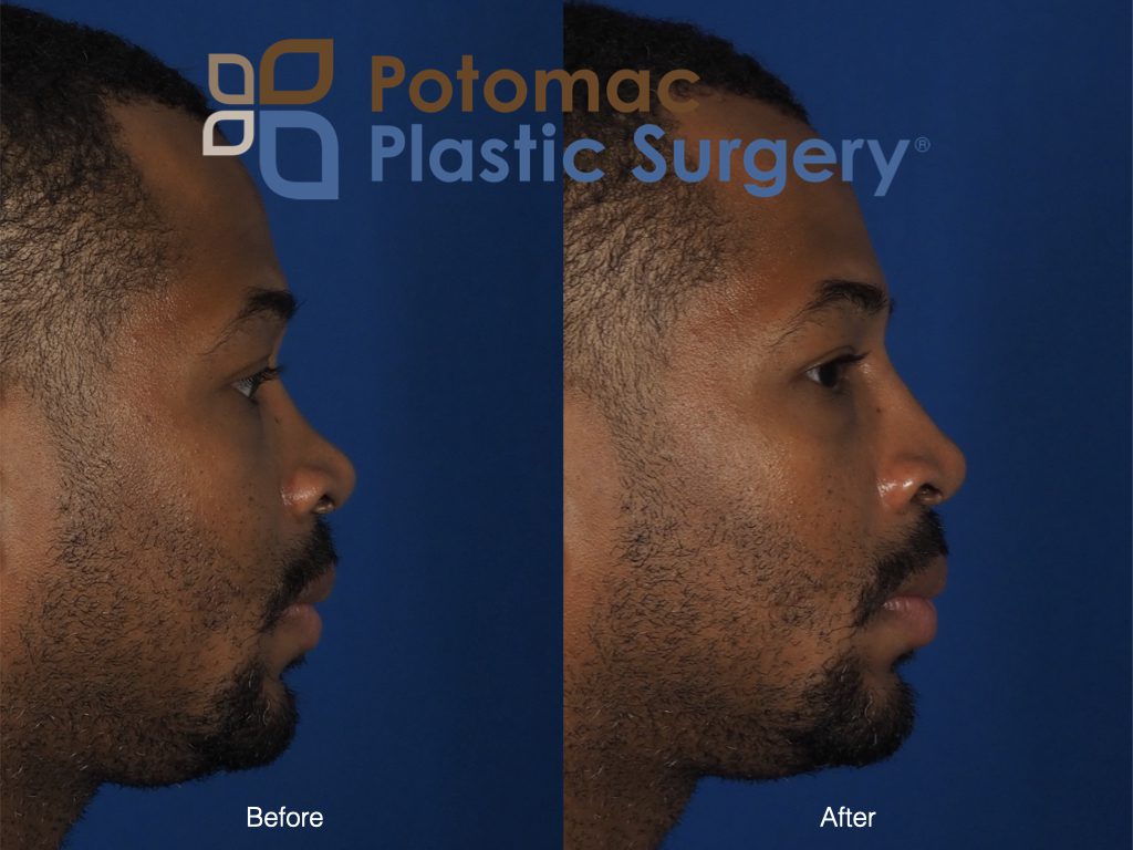 Nonsurgical rhinoplasty filler bridge