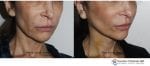 Blog post - 2 week before after mini facelift plastic surgery neck