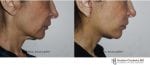 Blog post - 2 week before after mini facelift plastic surgery neck