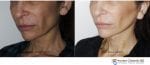 Blog post - 2 week before after mini facelift plastic surgery neck