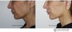 Blog post - 2 week before after mini facelift plastic surgery neck