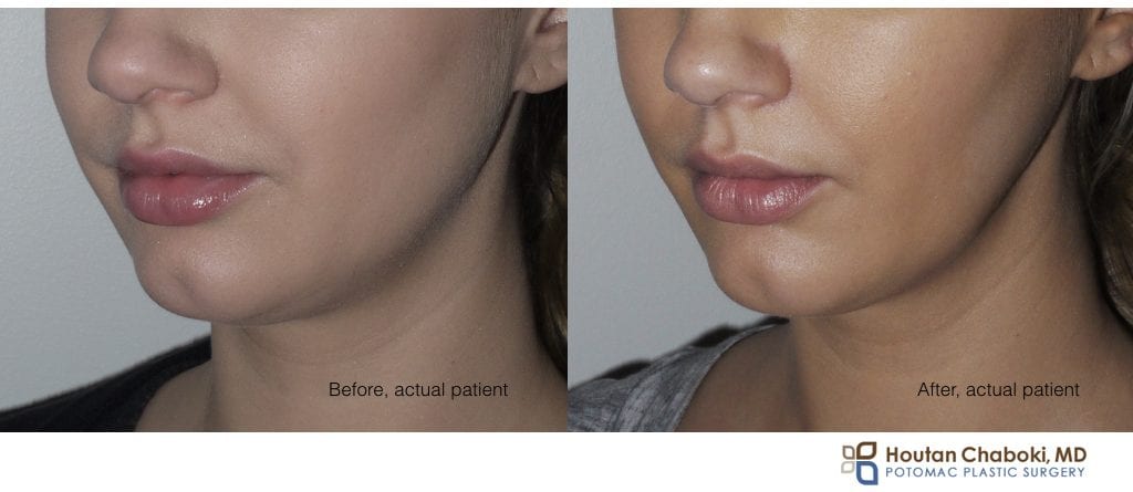 Blog post - before after Botox jaw reduction face neck