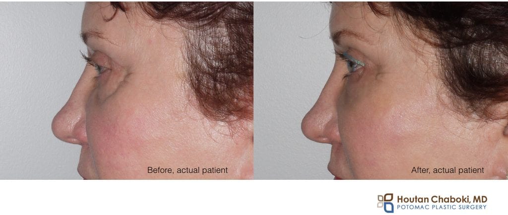 Blog post - before after photo liquid facelift HA filler