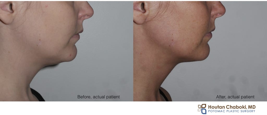 Blog post - before after Kybella nonsurgical neck fat reduction double chin