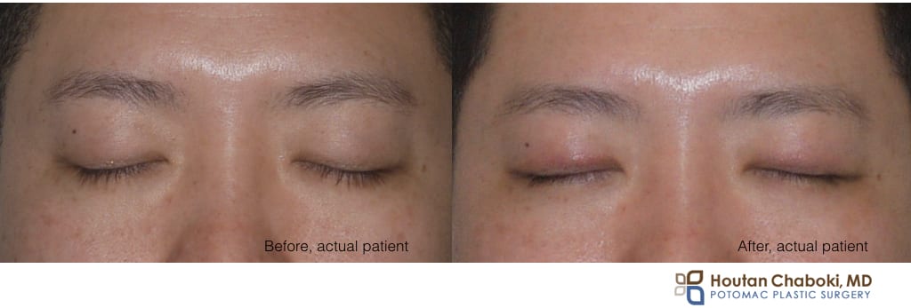 Blog post - before after photos double eyelid surgery Asian blepharoplasty