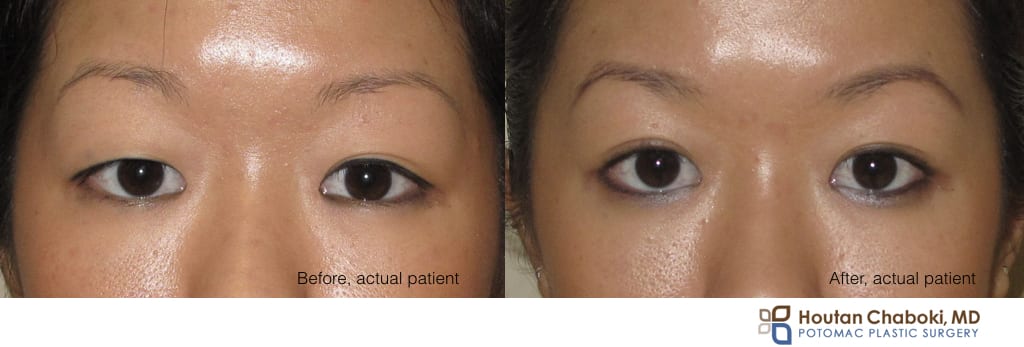 Blog post - before after photos double eyelid surgery Asian blepharoplasty