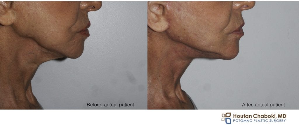 Blog post - before after revision facelift neck muscle