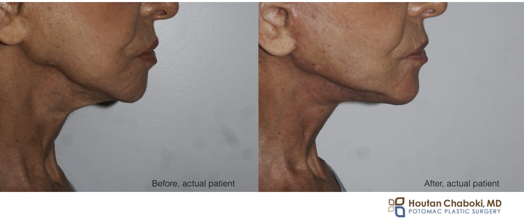 Blog post - before after revision facelift neck muscle