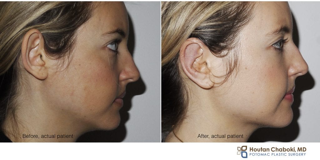 Blog post - before after 1 week otoplasty cosmetic ear surgery DC