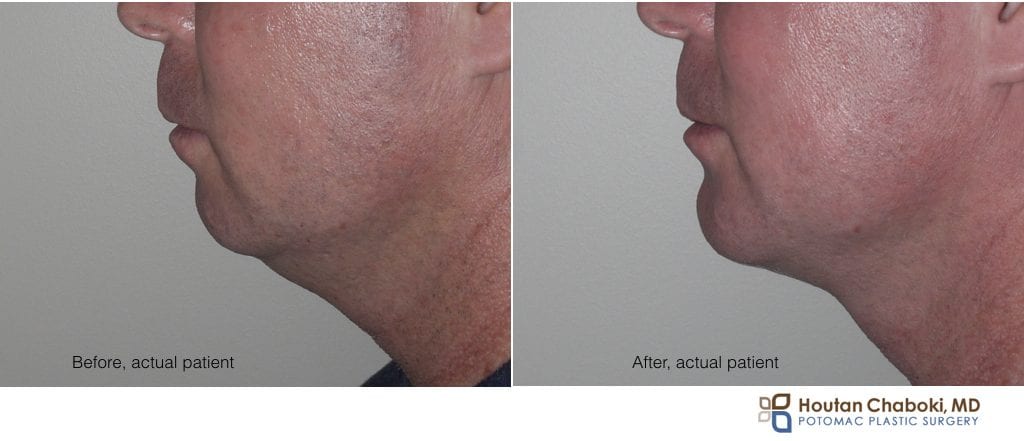 Blog post - before after photo overbite chin augmentation neck liposuction