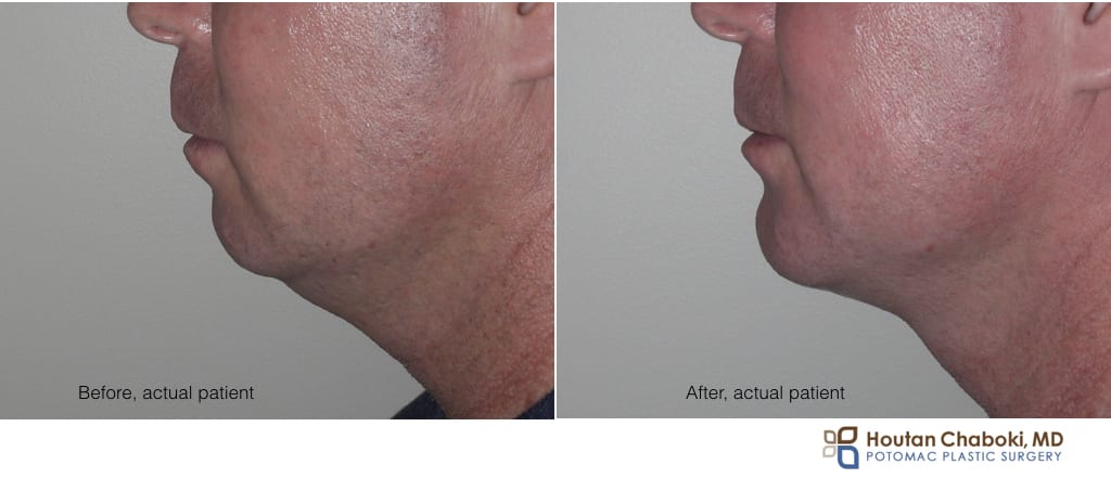 Blog post - before after photo overbite chin augmentation neck liposuction