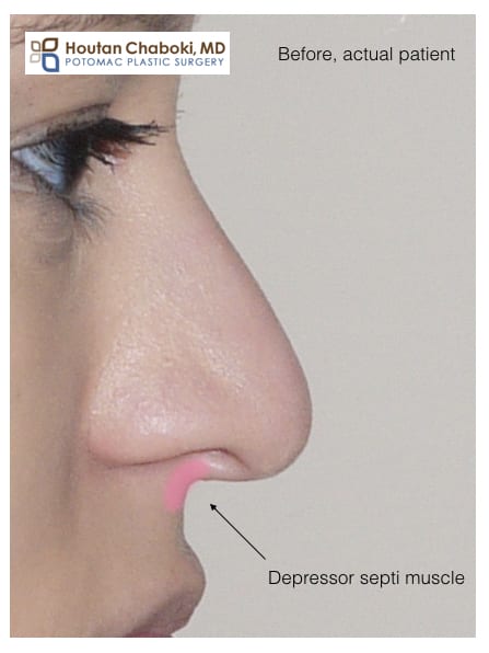 Blog post - depressor septi muscle droopy nasal tip