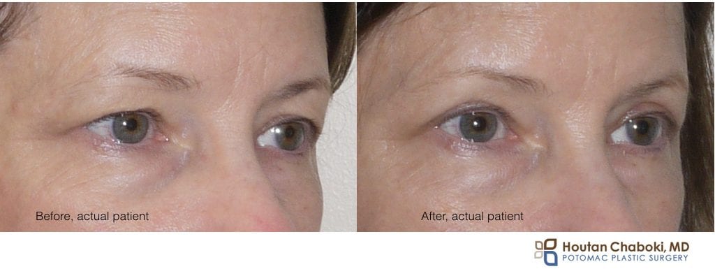 Blog post - before after photo upper eyelid surgery blepharoplasty