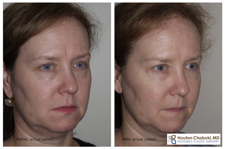 Facial fat injections for a rejuvenated appearance Potomac Plastic