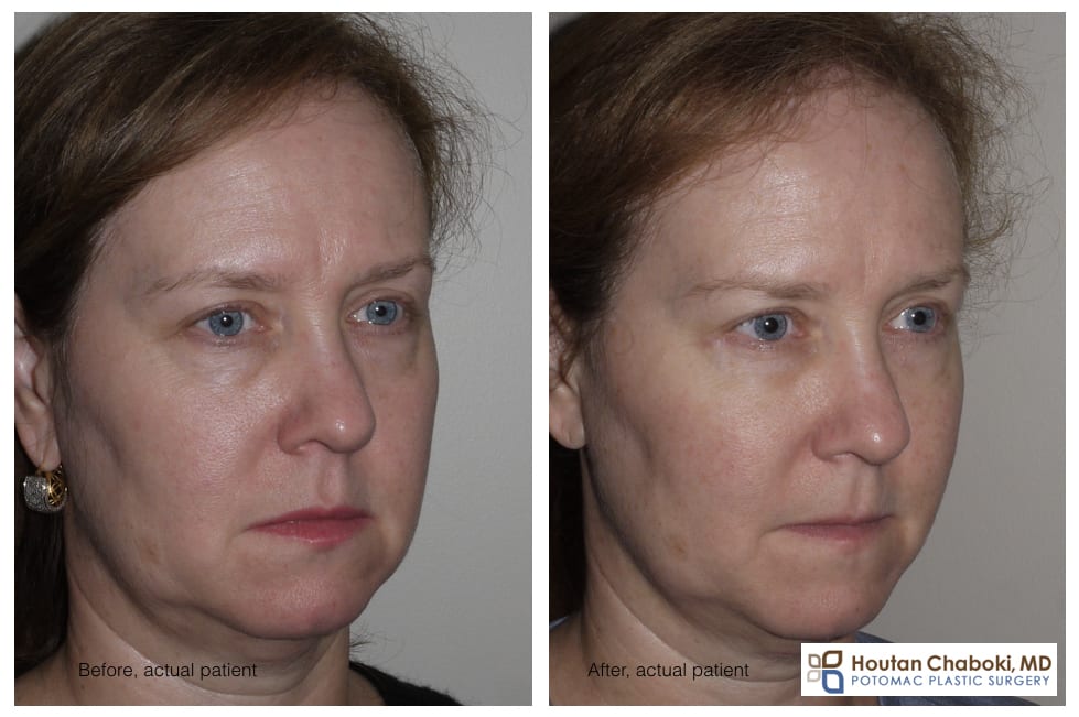 Blog post - before after photograph lower eyelid bag blepharoplasty surgery fat graft