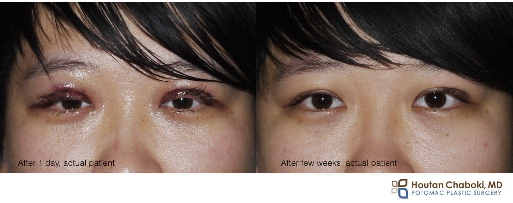 Blog post - facial plastic surgery swelling before after