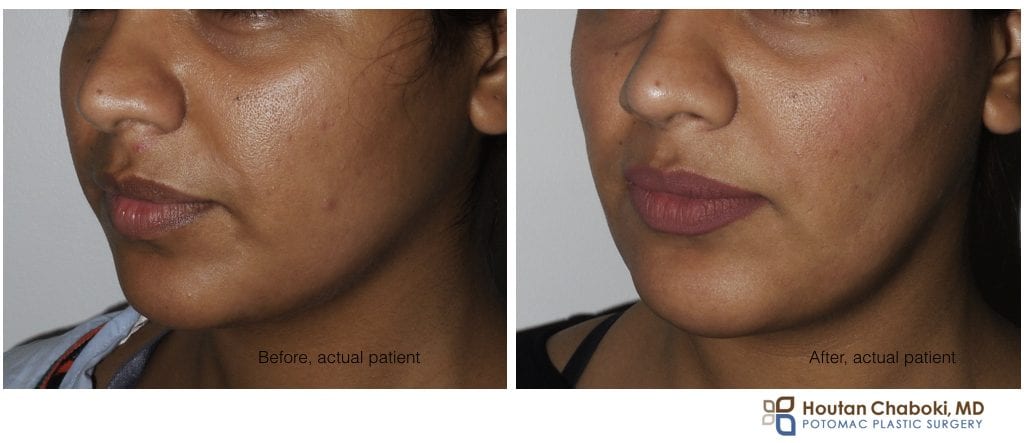 Blog post - before after buccal cheek fat reduction