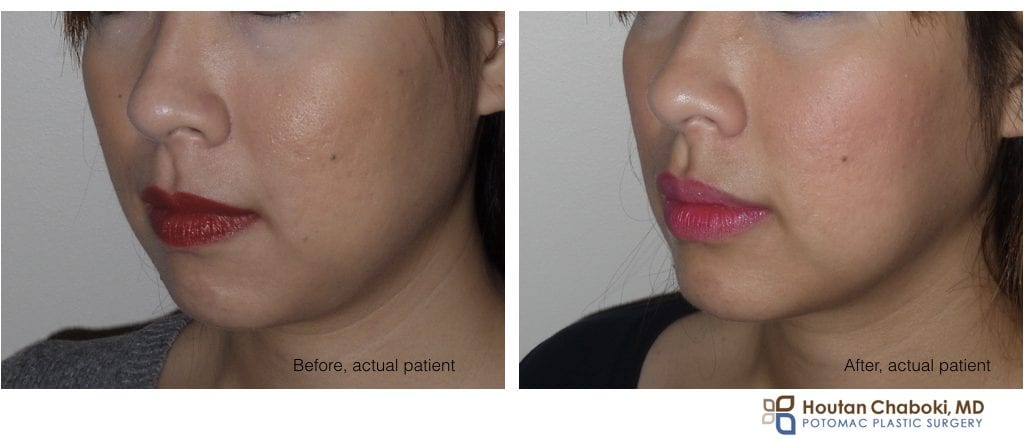 Blog post - before after lip enhancment facial filler injection