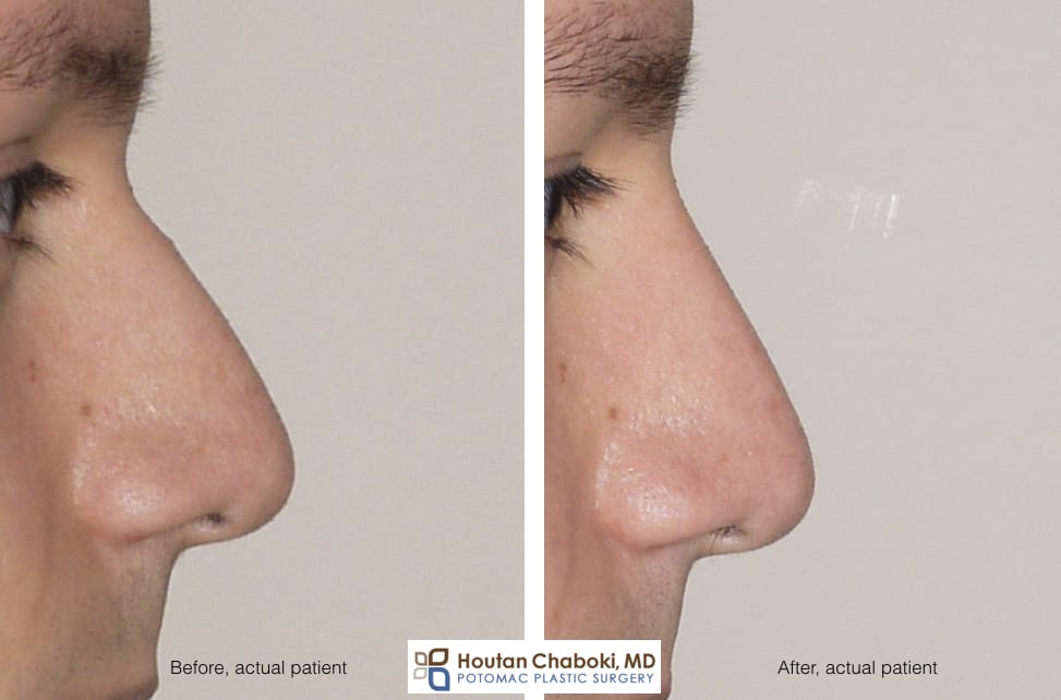 Blog post - before after radix graft rhinoplasty improve profile