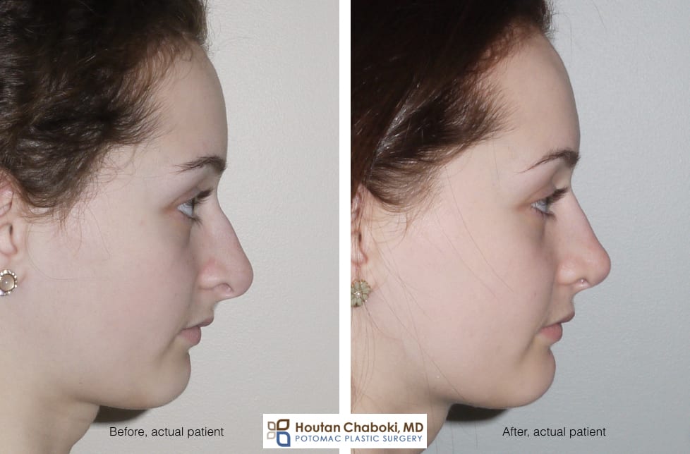 Blog post - before after radix graft rhinoplasty improve profile