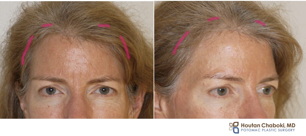 Blog post - limited incision brow lift endoscopic forehead lift