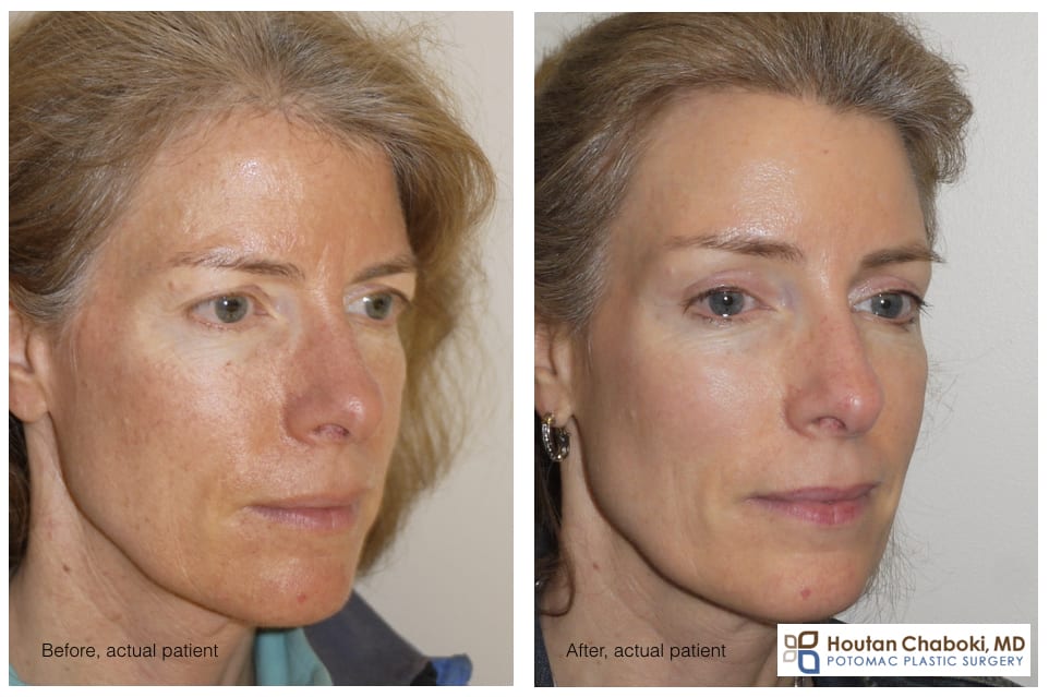 Blog post - limited incision brow lift endoscopic forehead lift