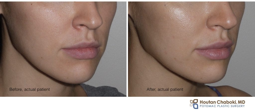 Blog post - prejuvenation prevention face wrinkle aging Botox filler skin care